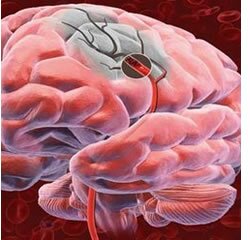Especialistas analisam prevenção e tratamento do AVC em Portugal