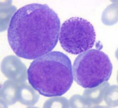Leucemia Mielóide Crónica: A doença rara que deixou de ser fatal